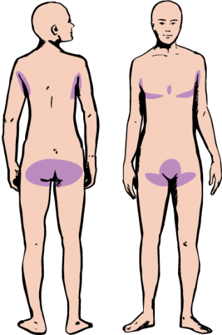 hidradenitis-suppurativa