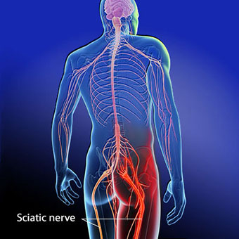 sciatica-sciatic-nerve