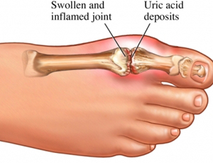 High-Uric-Acid-foods
