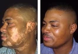 ginkgo-biloba-vitiligo