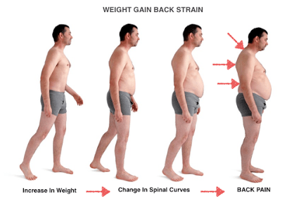 obesity-sciatica