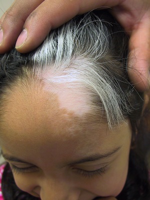 can vitiligo lead to hair loss