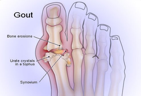 gout_illustration_