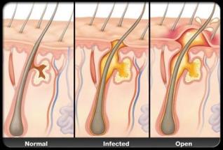 hidradenitis-suppurativa-vitamin-d-supplements