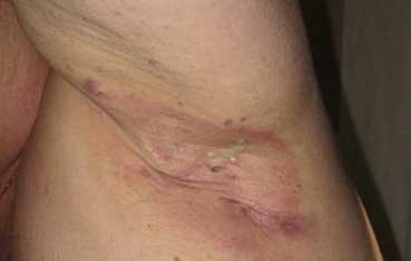 Hidradenitis-suppurativa_obese