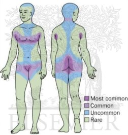 hidradenitis-suppurative-insulin