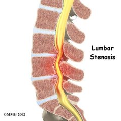 lumbar-stenosis