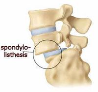 Spondylolisthesis
