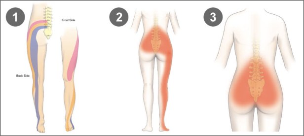 back-pain-constipation