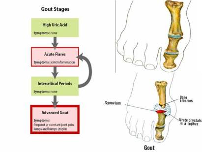 drugs that cause gout