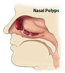 nasal-polyps