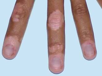 0-stop-vitiligo-spreading