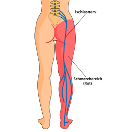 rueckenschmerzen-durch-gereizten-ischiasnerv