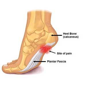 plantar fasciitis essential oils