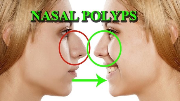 nasal polyps swollen nose