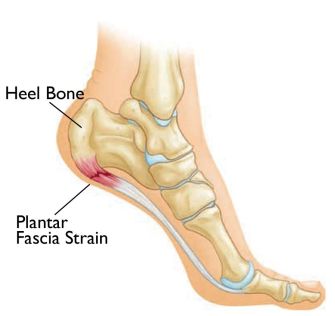 plantar-fasciitis-pain