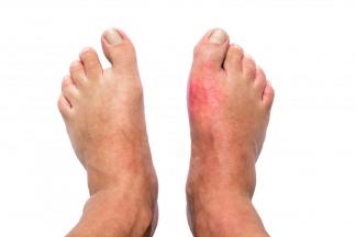 gout-remedies