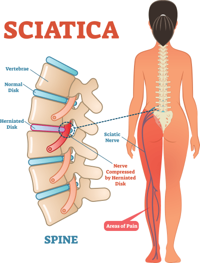 6 Things That Can Worsen Your Sciatica