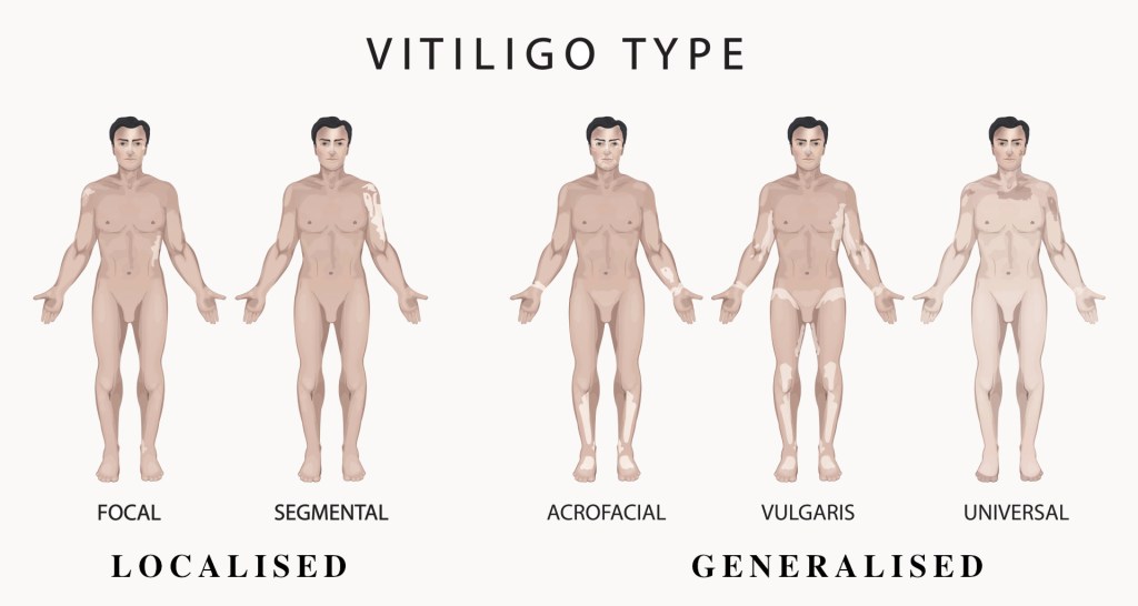What are the Different Types of Vitiligo?