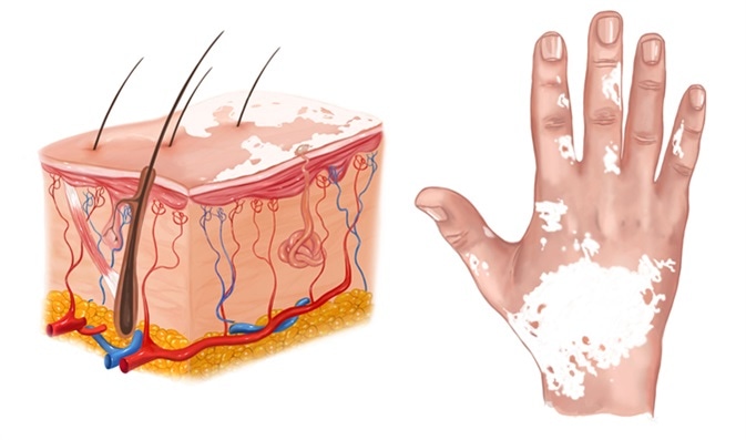 Vitamin B12 and Folic Acid for Vitiligo