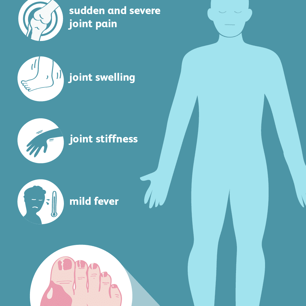 Symptoms of High Uric Acid