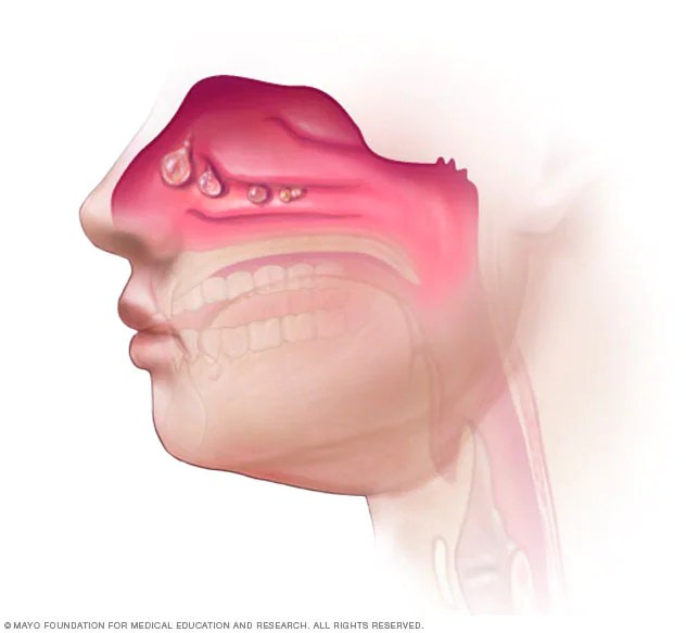 Vitamin D for Nasal Polyps