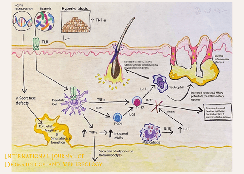 Understanding Hidradenitis Suppurativa