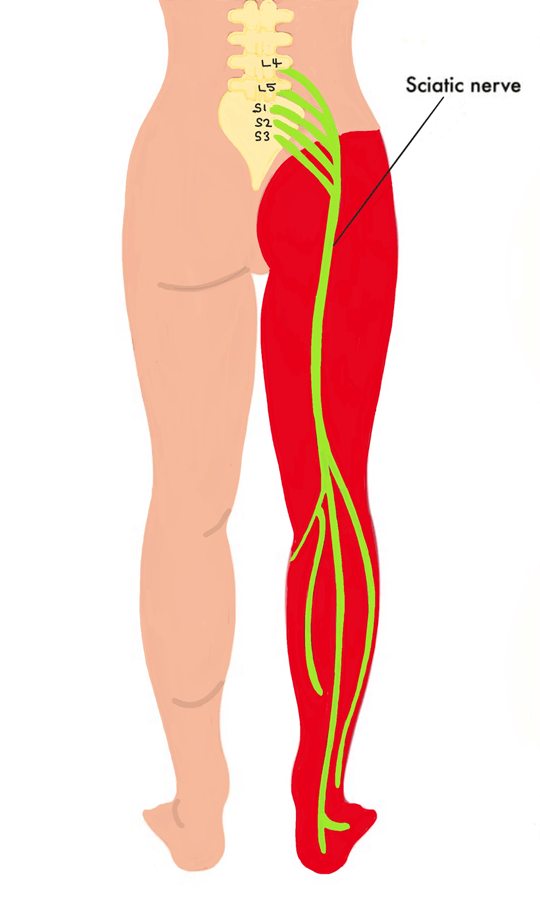 sciatica pain